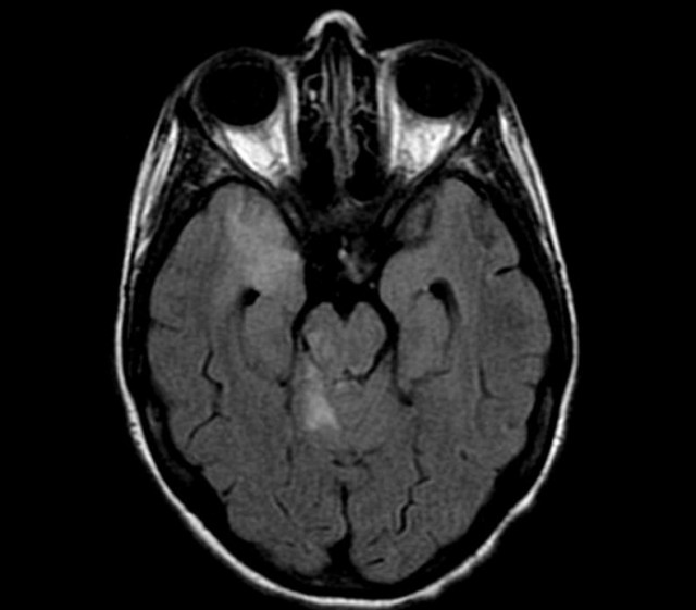 Cerebrovascular