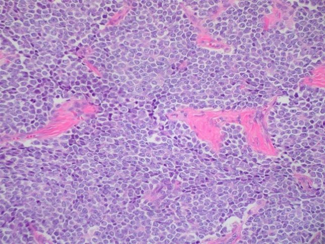 Este tipo de tumor afecta principalmente a niños y adolescentes