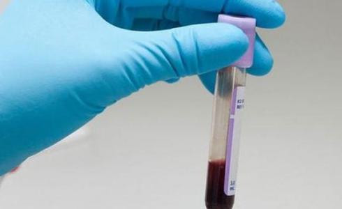 Un análisis de sangre podría sustituir las biopsias en cáncer de pulmón