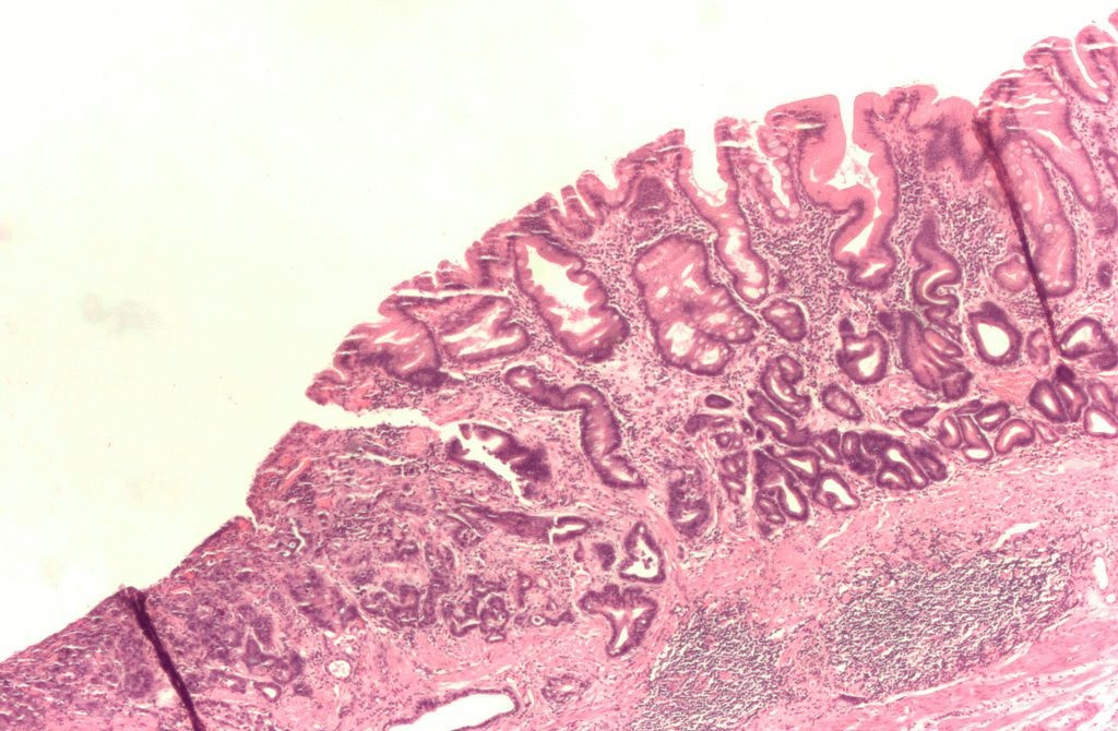 Adenocarcinoma gu00e1strico