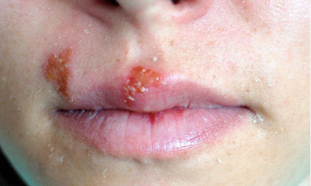 Herpes labial