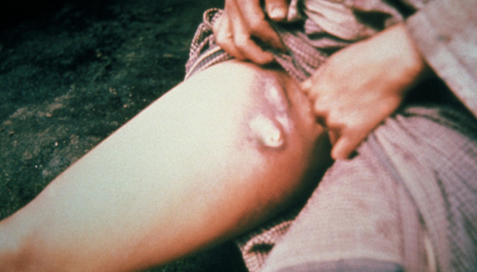 Plague buboes 1