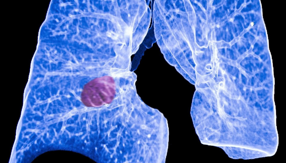 Cáncer de pulmón