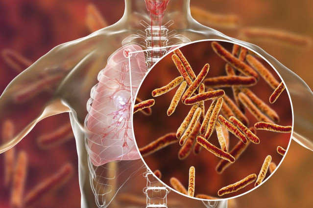 Tuberculosis