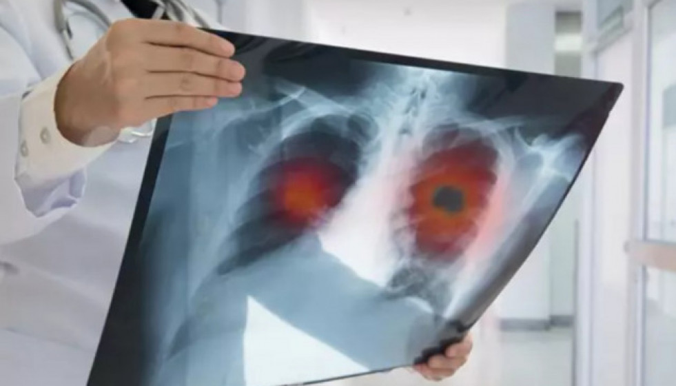 Catalunyapressaugmentcancermon
