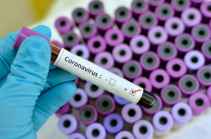 Coronavirus positive  Blood sample with respiratory coronavirus positive