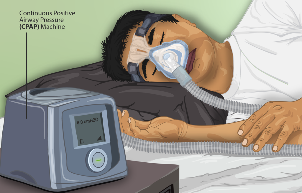1024px Depiction of a Sleep Apnea patient using a CPAP machine